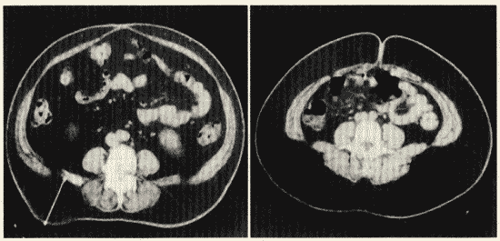 お腹をCTスキャンで撮影した写真（左が内臓脂肪型肥満、右が皮下脂肪型肥満）